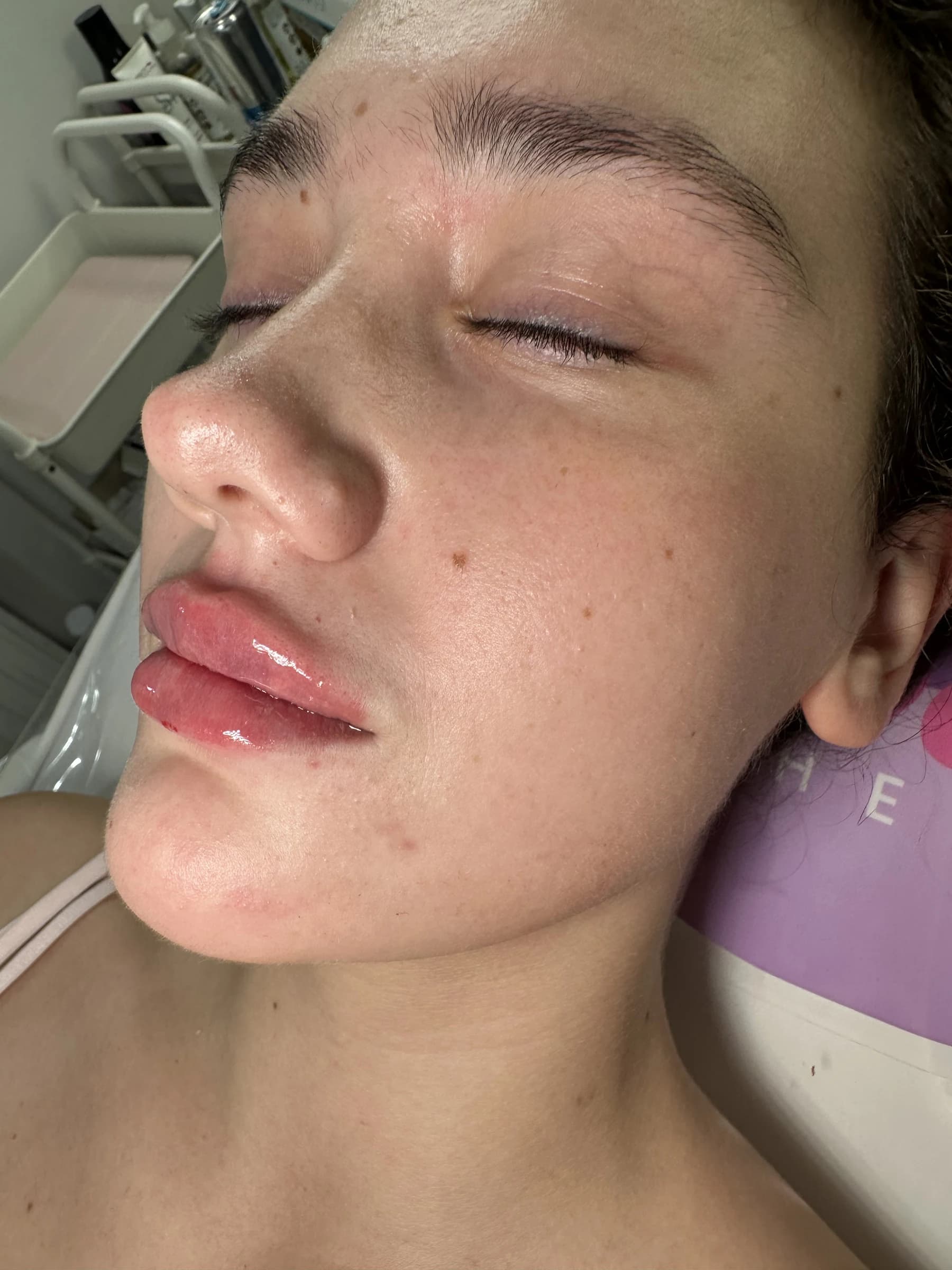 Anti-Wrinkle Injections at Bomb Doll Aesthetics